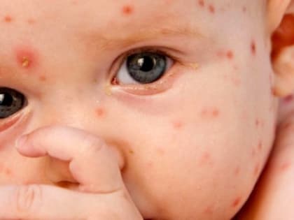 В Новосибирской области вакцинируют от кори 22 тысячи человек