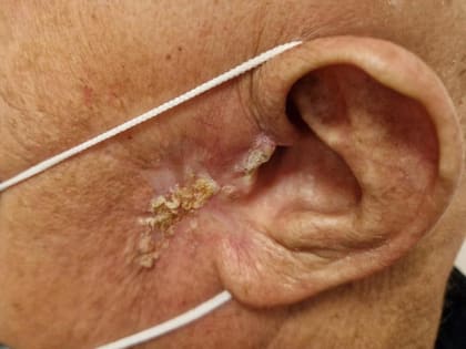 В Новосибирске страдающего пациента спасли от адских болей из-за рака