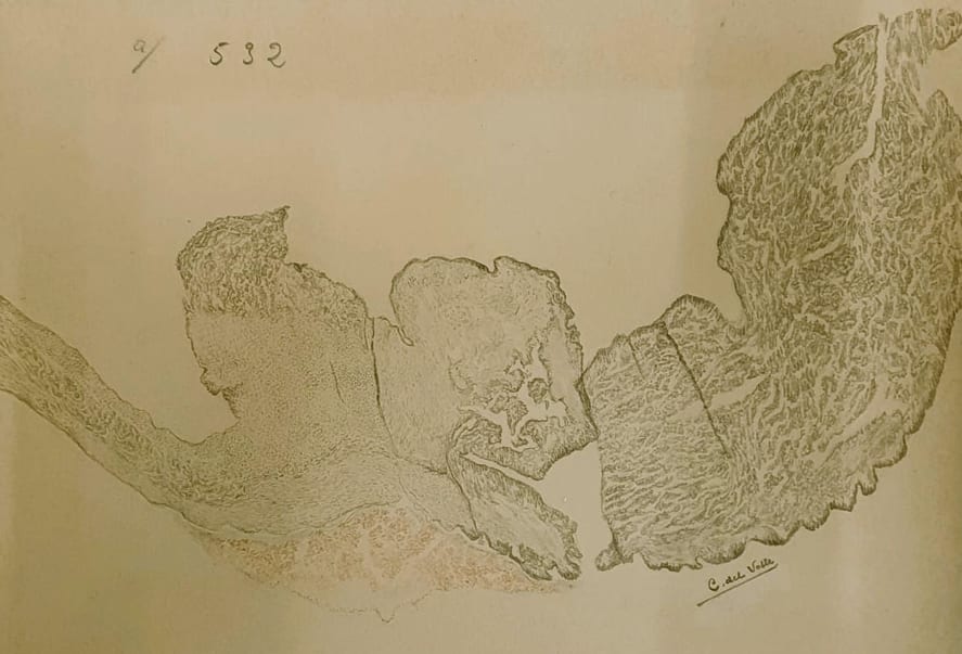 Primer dibujo conocido de Conchita del Valle. 1 lustración realizada por C.V. a partir
de un fragmento de una vegetación de la válvula mitral obtenida en el curso de la autopsia
de una paciente con endocarditis lenta de origen estreptocócico. Realizado en 1930
(Baquero et al., 2022). Fuente:
http:/ / gesdoc. isci i i. es/ gesdoccontrol ler?action =down load&id=29 /06/2022-1 ed6789b30.