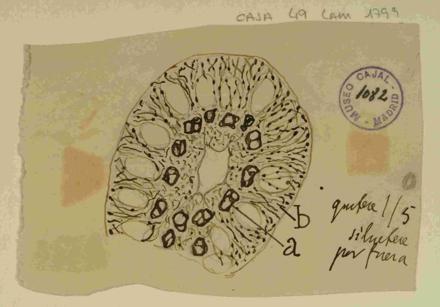"Epitelioma pavimentoso lobulado de la piel de la nariz". En esta ilustración de un carcinoma, Cajal no se limita a dibujar las células tumorales (A), sino que representa todo el ecosistema: el estroma reactivo (B), los vasos sanguíneos (b) y, de manera crucial, la infiltración de células inmunes (e). Es la visualización directa de su concepto de "reacción defensiva" y un retrato del microambiente tumoral un siglo antes de su definición formal. URL: http://simurg.csic.es/view/9918477555804201