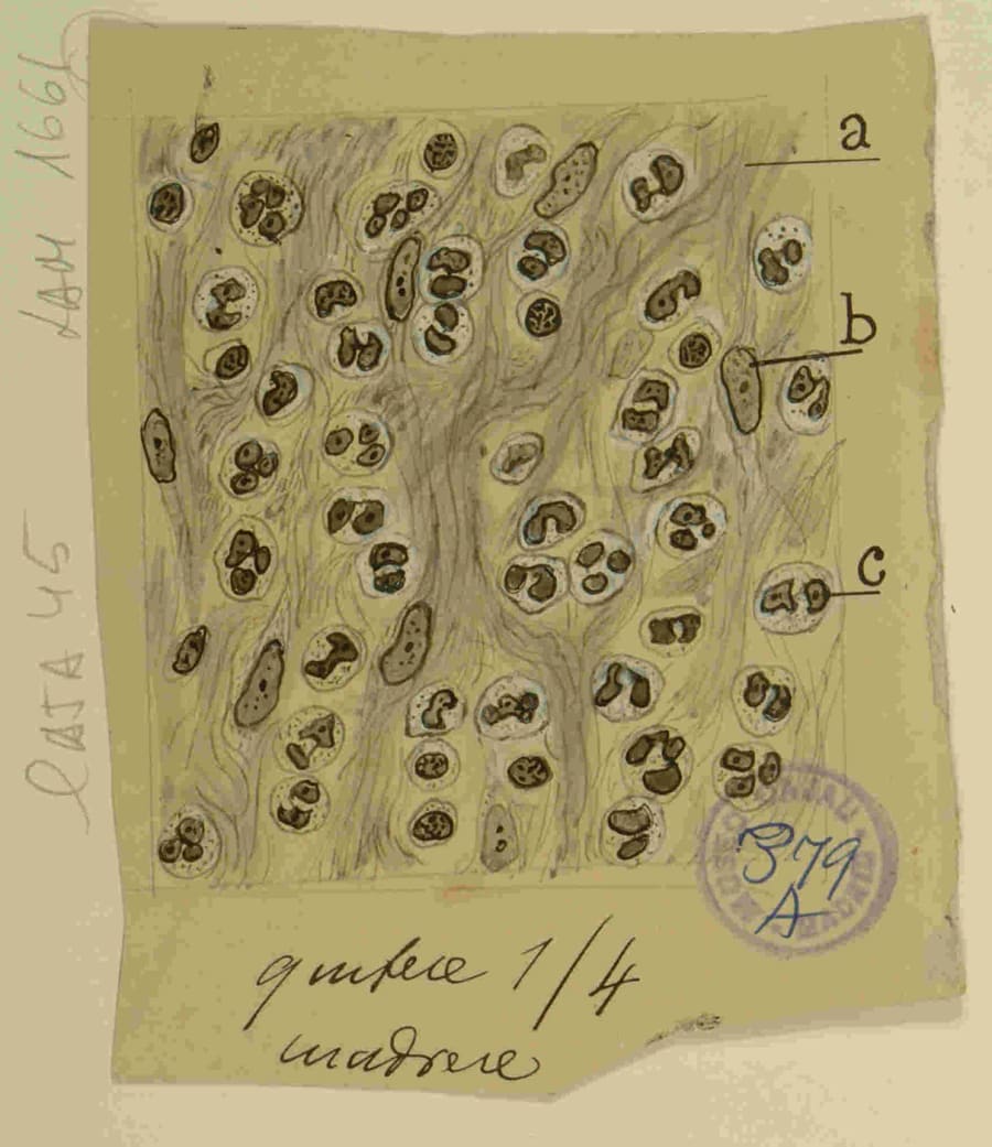 "Infiltrado inflamatorio agudo". Este dibujo, que muestra un denso infiltrado de leucocitos (neutrófilos, reconocibles por sus núcleos multilobulados), es la representación del resultado final del proceso de diapédesis. Mientras que otros dibujos de Cajal detallan el viaje de un solo