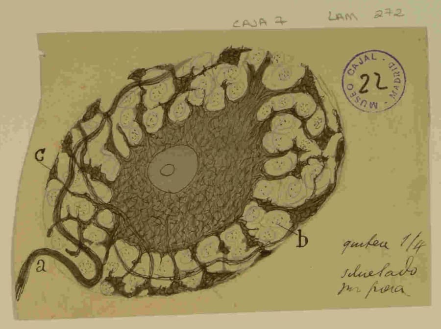 Célula piramidal en avanzado estado de transformación senil, dibujada por Santiago Ramón y Cajal. Esta ilustración, procedente de las preparaciones que Cajal estudió de cerebros con demencia, es un testimonio directo de su análisis de la patología neuronal. Se observa el colapso de la estructura celular: el soma o cuerpo neuronal aparece encogido, mientras que las dendritas se muestran deformadas y con sus espinas alteradas. El dibujo no solo documenta la degeneración, sino que refleja la interpretación mecanicista de Cajal sobre la muerte celular en la demencia senil. Cortesía del Legado Cajal (CSIC). 9918477363004201. http://simurg.csic.es/view/9918477363004201/