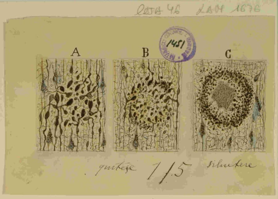 Dibujo científico de Santiago Ramón y Cajal, las placas seniles de la corteza cerebral de un viejo atacado de demencia. / Santiago Ramón y Cajal. 9918477719304201. http://simurg.csic.es/view/9918477719304201/
