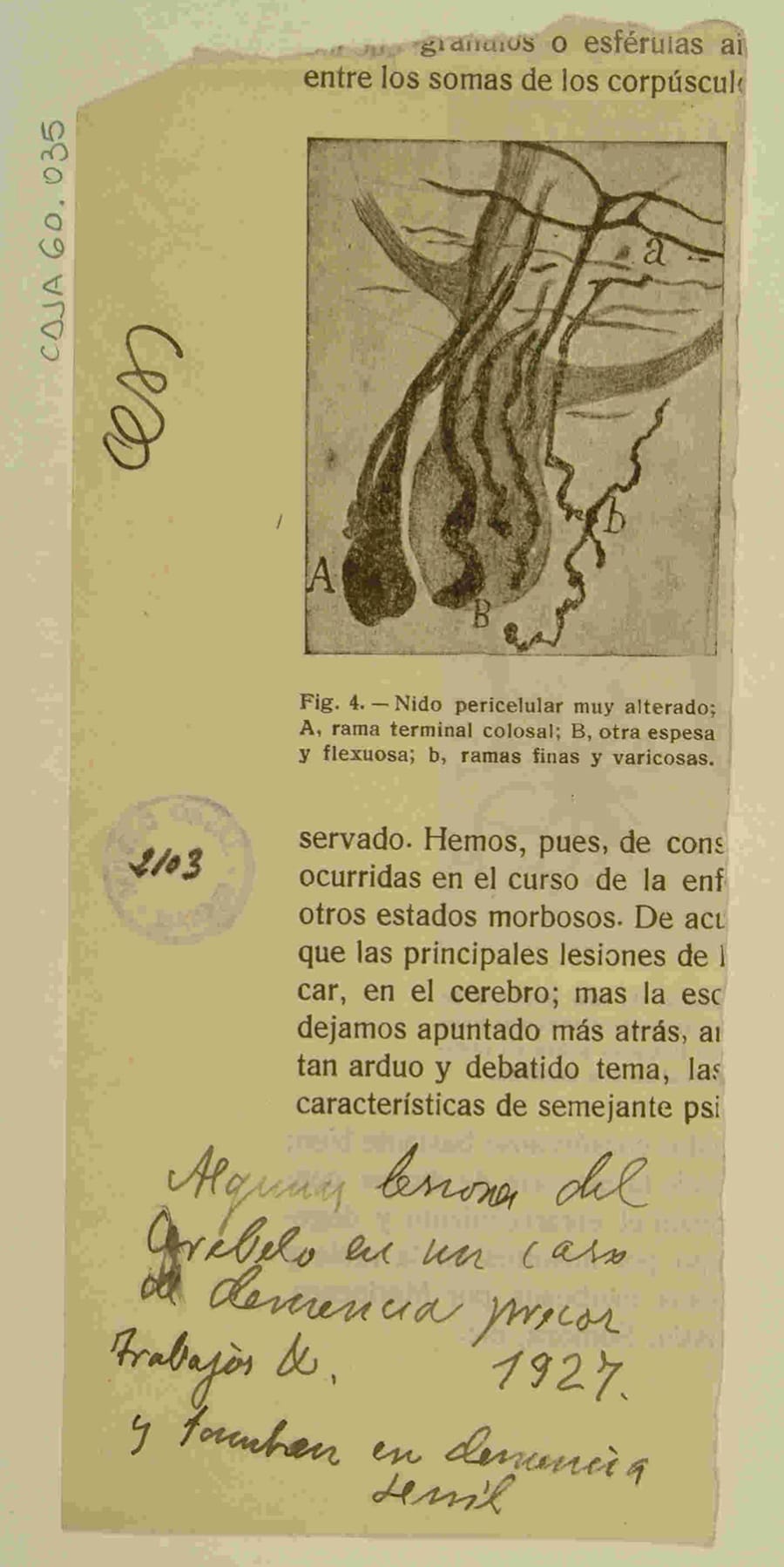 Lesiones en el cerebelo en un caso de demencia, según anotación manuscrita de Cajal (1927). Esta imagen, extraída de una de sus publicaciones, muestra un "nido pericelular muy alterado", es decir, la degeneración de las terminaciones axónicas que rodean el cuerpo de una neurona. La anotación de puño y letra de Cajal —"Algunas lesiones del cerebelo en un caso de demencia precoz y tambien en demencia senil"— es una prueba documental de su investigación continuada y directa sobre la patología de la demencia en etapas avanzadas de su carrera. El dibujo ilustra el colapso de la conectividad sináptica, el verdadero sustrato funcional de la enfermedad según el marco de la Doctrina de la Neurona. Cortesía del Legado Cajal (CSIC). 9918477811704201.