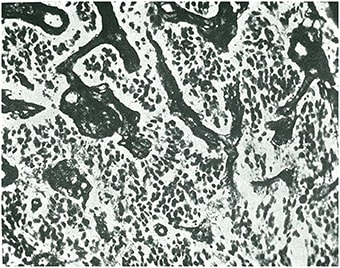 Figura 2. Glioblastoma isomórfico, según la terminología de Río-Hortega.