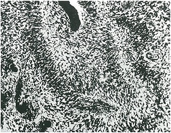 Figura 3. Otro ejemplo de glioblastoma isomórfico con disposición ondulada de los glioblastos.