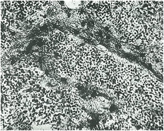 Figura 5. Ejemplos de oligodendrocitoma.