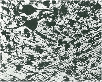 Figura 6. Neurocitoma. Nótense las células gangliocíticas y un plexo de fibras amielínicas.