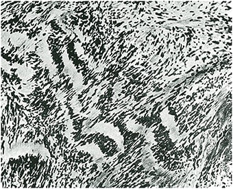 Figura 7. Neurinoma. Agrupación de los núcleos en filas o empalizadas.