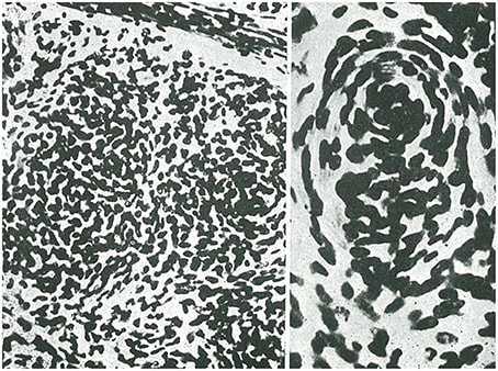 Figura 8. Exotelioma meníngeo. Las células desordenadas forman cúmulos y capas concéntricas o acérvulos.