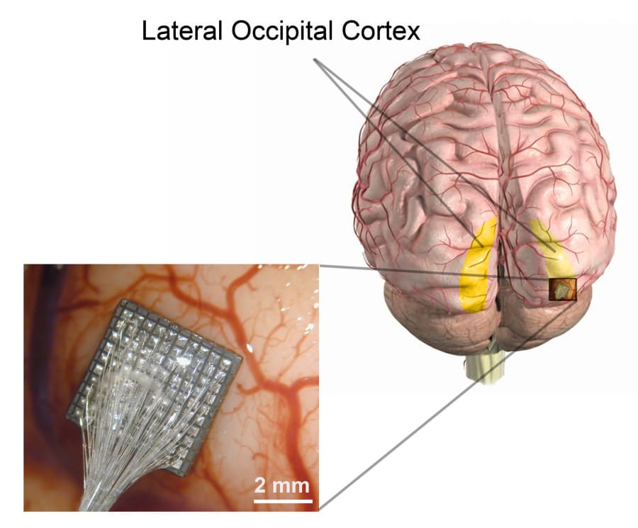 Imagen del cerebro destacando la corteza occipital lateral, con una sección ampliada que muestra un dispositivo de estimulación cerebral y la vascularización cerebral.