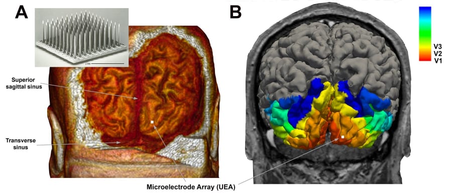 Imagen A: Microelectrodo array de 2 mm de altura, mostrando puntas metálicas. Imagen B: Representación 3D del cerebro humano con áreas coloreadas que indican diferentes regiones visuales, incluyendo los senos sagital y transverso.