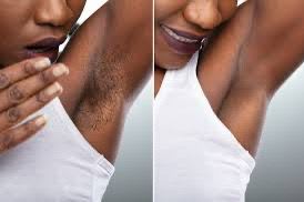 Laser Hair Removal