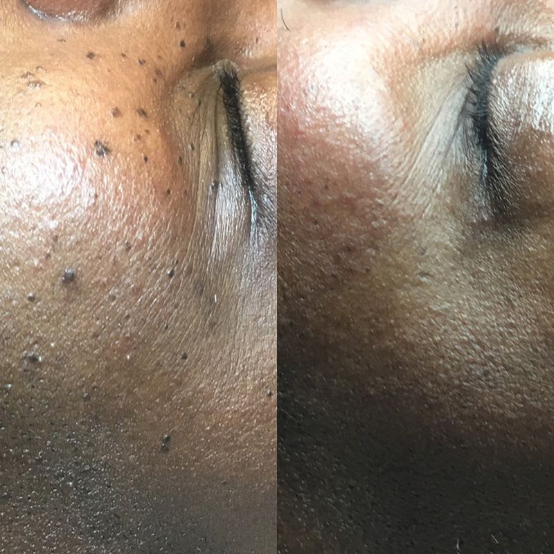 Wart Removal Therapy