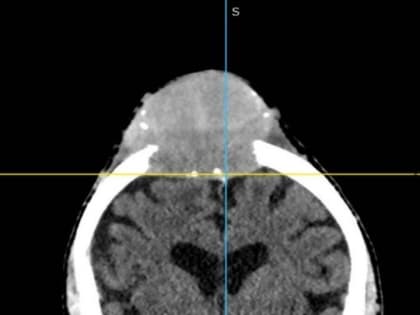 Состояние здоровья 78-летнего пациента в Татарстане вызывает беспокойство