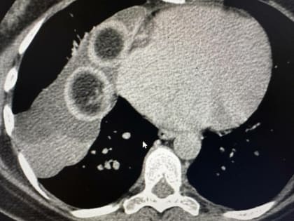 В РКБ удалили кисту с клубками волос, которая выросла рядом с сердцем