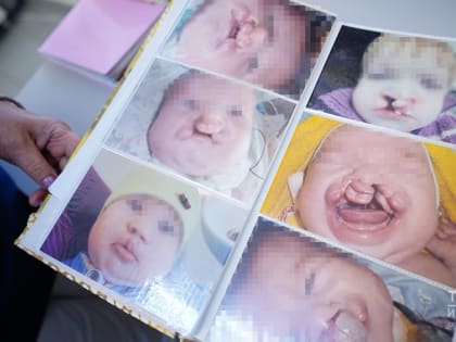 «Мамы приходят в панике, а уходя, плачут от счастья»: ортодонт о лечении «заячьей губы»