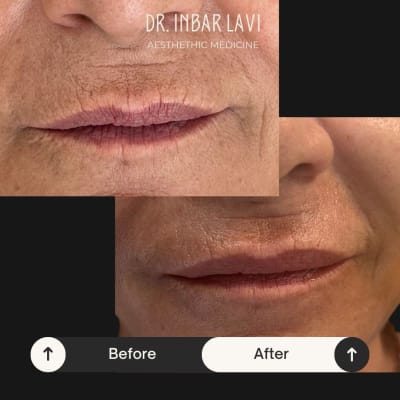 תוצאות לפני ואחרי הזרקת פולינוקלאוטידים בשפתיים להעלמת קמטוטים