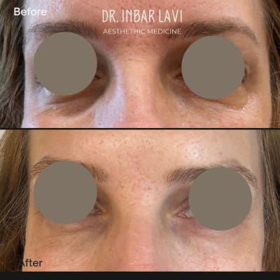 תוצאות לפני ואחרי הזרקת פולינוקלאוטידים מתחת לעיניים לטשטוש כהויות