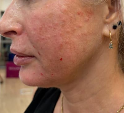 תוצאות טיפול בפולינוקלאוטידים - לפני ואחרי