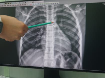 В Новосибирске врачи извлекли из бронхов ребёнка канцелярскую кнопку