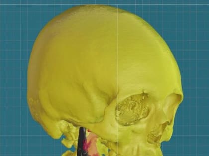 Челюстно-лицевые хирурги БСМП им. Н.С Карповича спасли пациентку, протез которой оказался опасно близко к мозгу