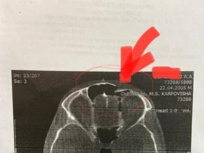 Красноярские врачи восстановили лицо подростку, получившему вдавленный перелом лба