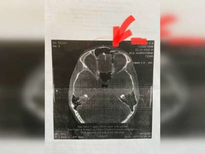 Красноярские ЛОР-врачи провели сложнейшую операцию подростку