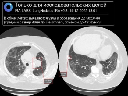 В Краевом онкодиспансере исследовали применение искусственного интеллекта для ранней диагностики рака легкого