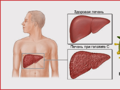 Профилактика вирусных гепатитов                                                            