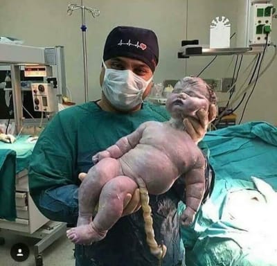 Foshnja më e madhe e lindur habit botën: 7.9 KG dhe 57.5 CM gjatësi !!