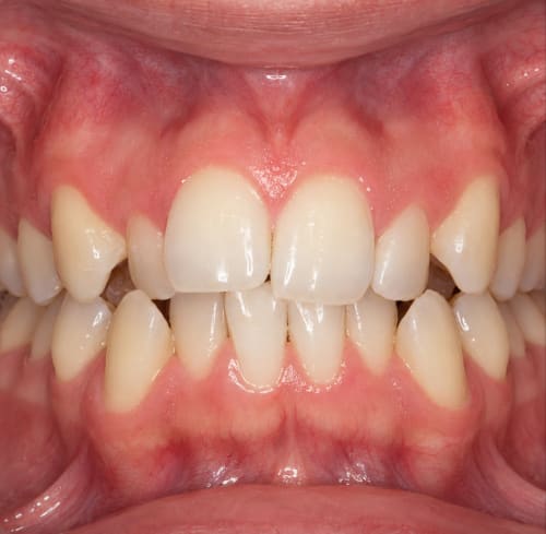 Caso clínico: apiñamiento dental con dientes amontonados y rotados en el sector anterior