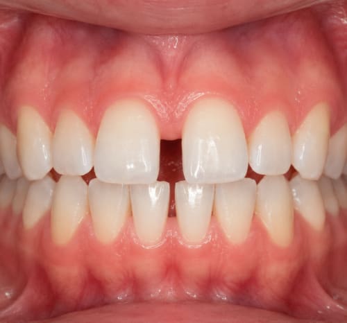 Caso clínico: diastema con un espacio visible entre los incisivos centrales superiores