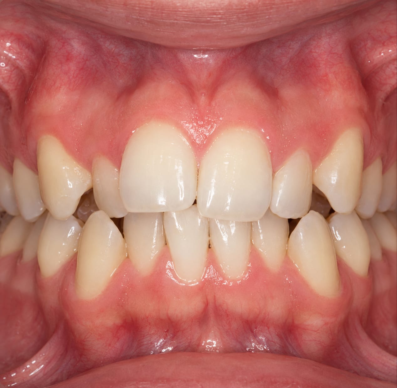 Caso clínico: apiñamiento dental con dientes amontonados y rotados en el sector anterior
