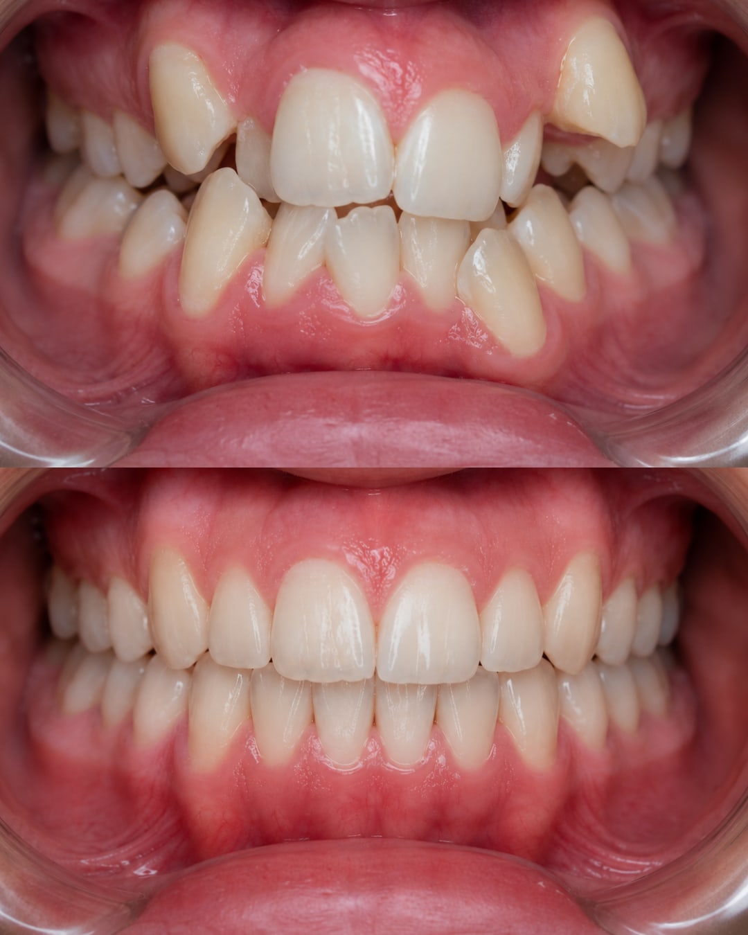 Caso destacado · Apiñamiento severo tratado con Invisalign Comprehensive en 18 meses