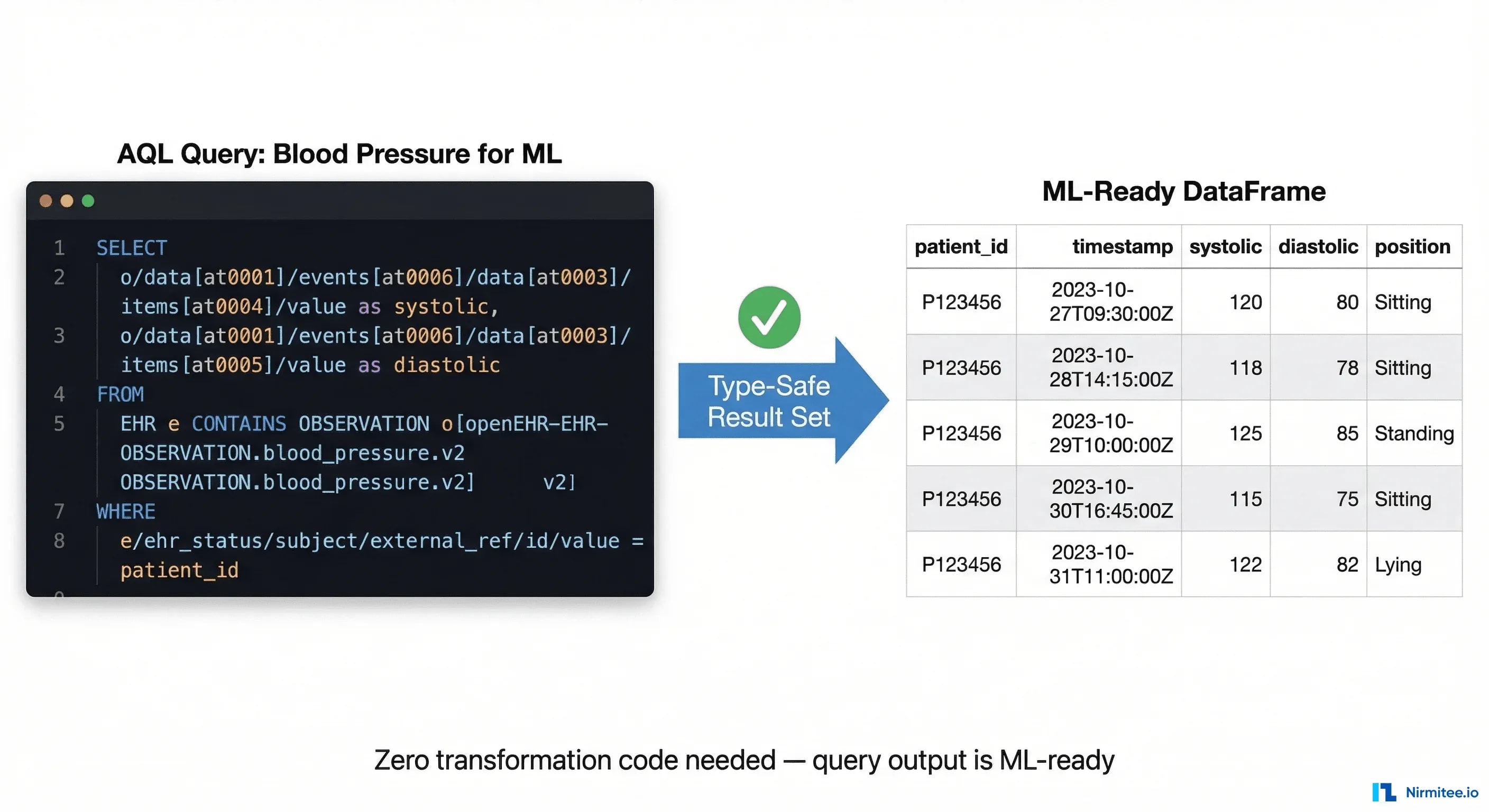 AQL query workflow showing type-safe extraction from openEHR CDR to pandas DataFrame