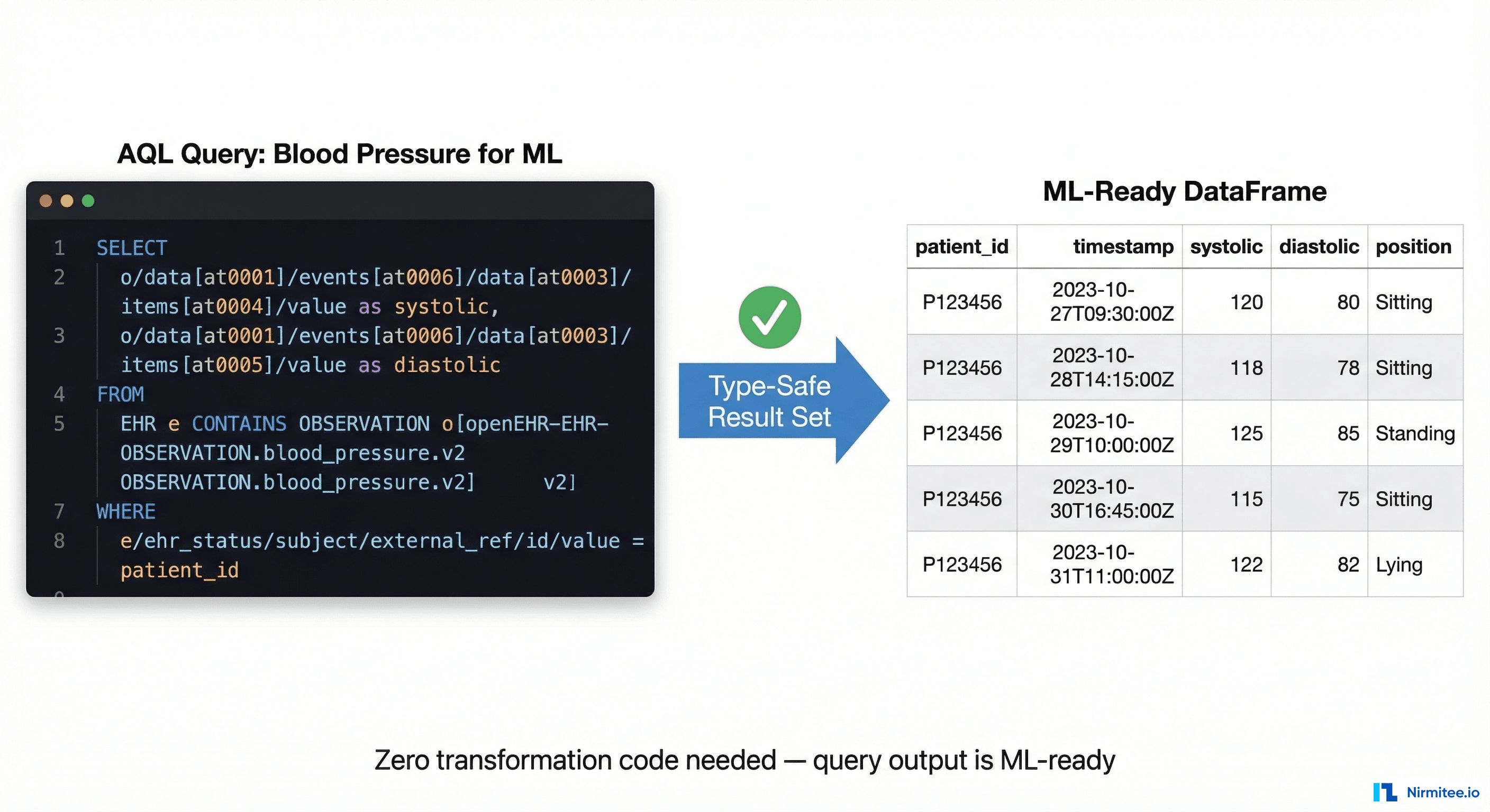 AQL query workflow showing type-safe extraction from openEHR CDR to pandas DataFrame with zero transformation code needed