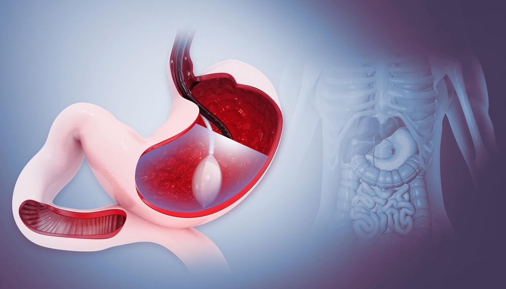 Gastric Balloon Procedure at Nile International Hospital