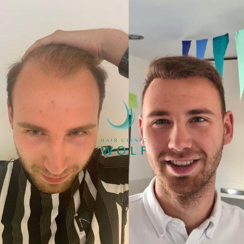 Natuurlijke haarlijn na een haartransplantatie Hair Clinic Wolf 5* Service