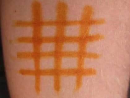 Мифы о йодной сеточке: Почему это не работает