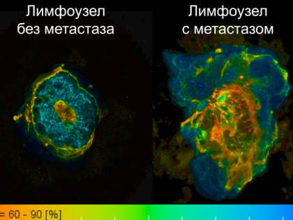 Метод быстрой диагностики лимфоузлов при раке груди разработан в ПИМУ
