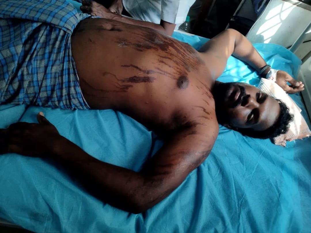 అమలాపురంలో భర్తపై యాసిడ్ దాడి..