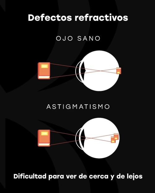 Instituto Nano - Cirugía refractiva