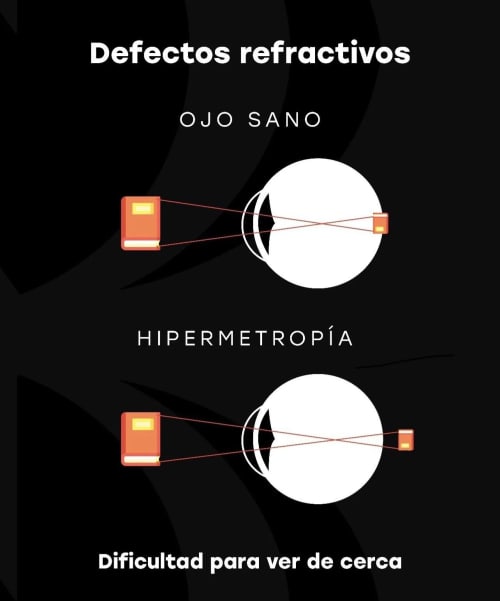 Instituto Nano - Cirugía refractiva