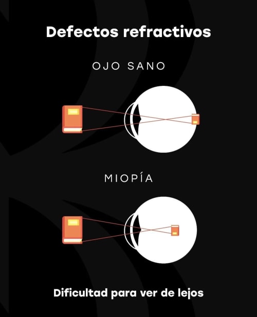 Instituto Nano - Cirugía refractiva