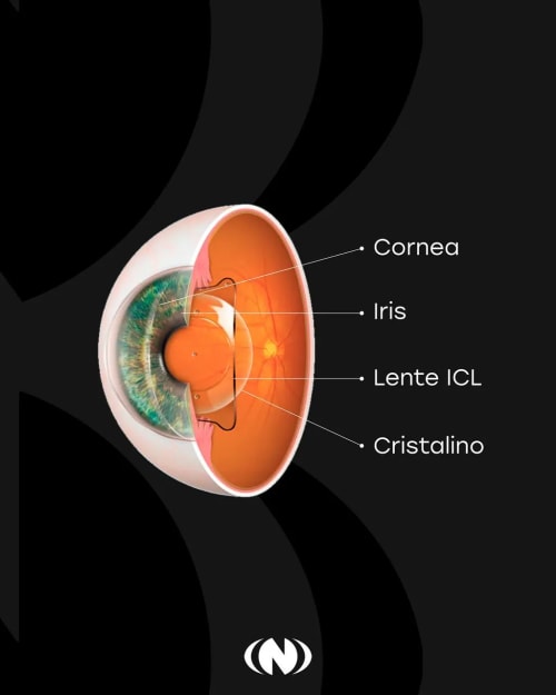 Instituto Nano - Cirugía refractiva