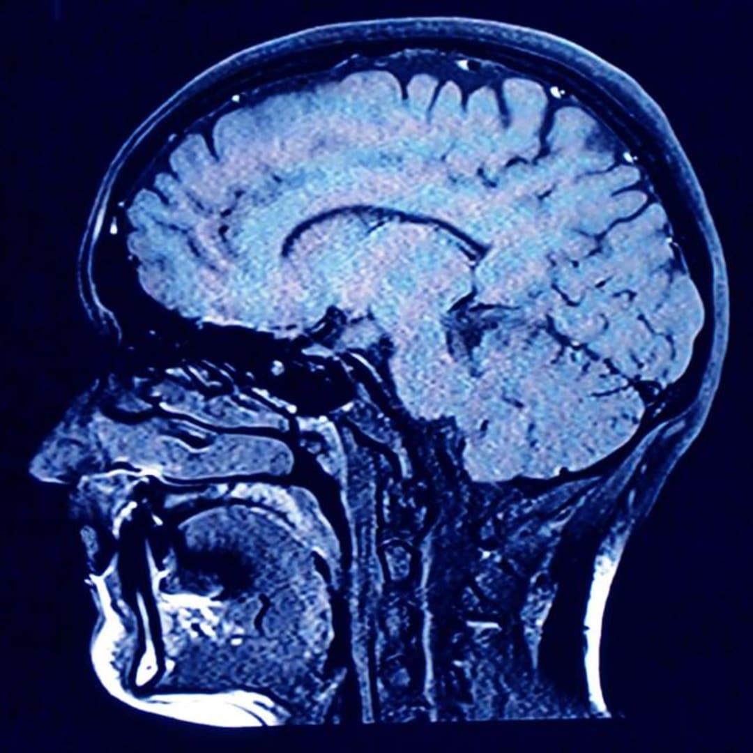 Mikroplastik Menumpuk dalam Otak Manusia: Ancaman Baru yang Mengkhawatirkan