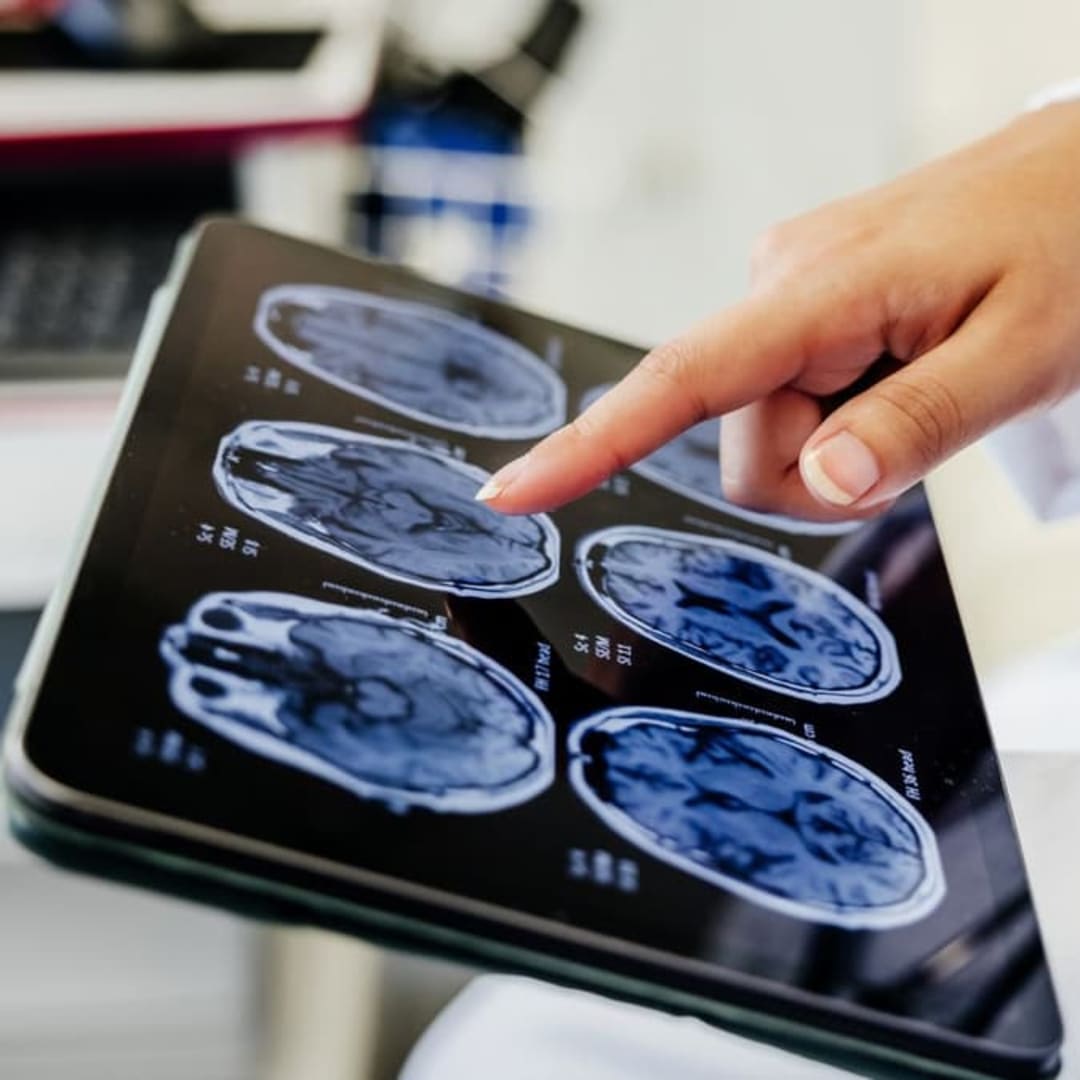 Nanoflowers Inovatif: Harapan Baru untuk Mengatasi Kerusakan Sel Otak