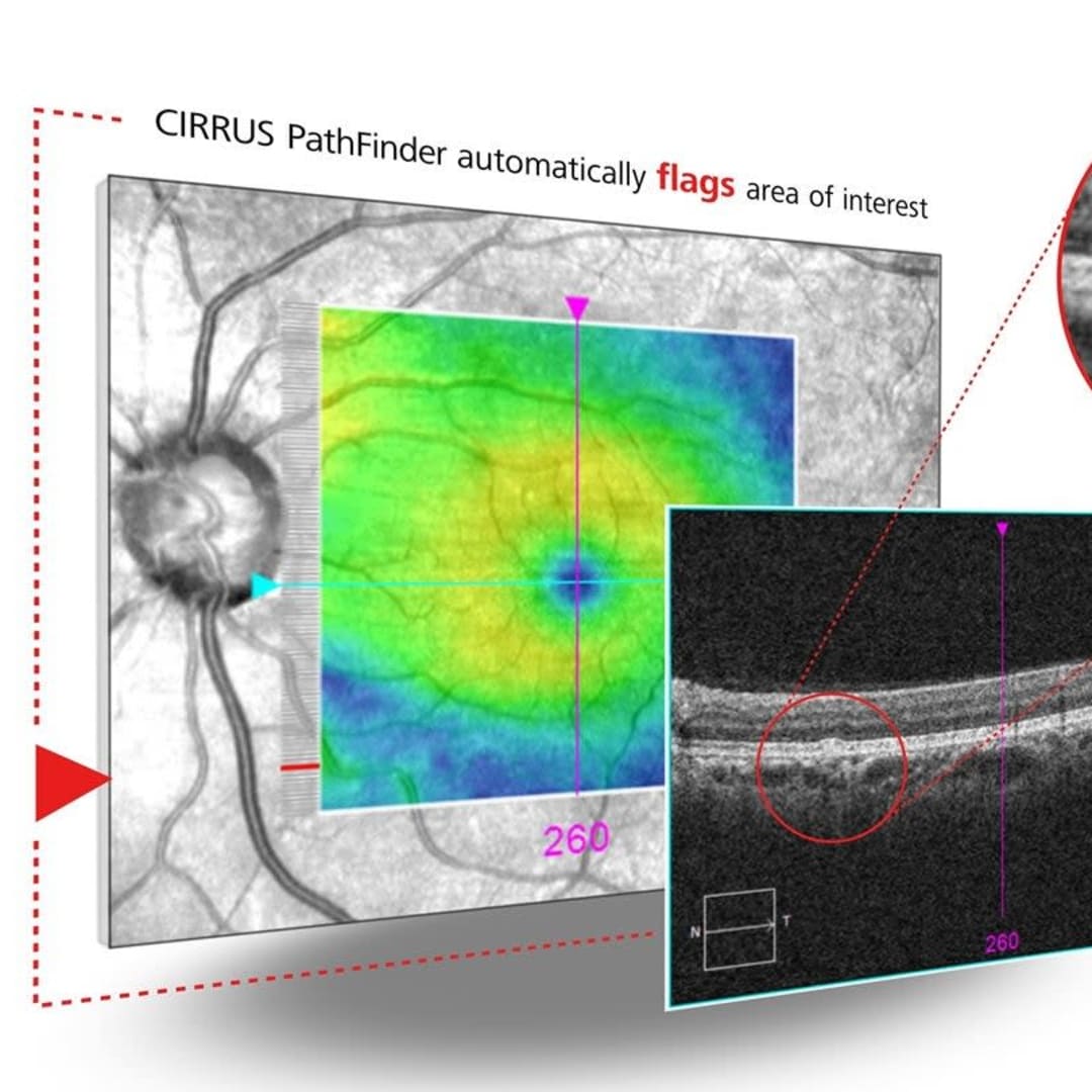 Zeiss CIRRUS PathFinder: Alat AI Canggih untuk Bantu Diagnosis Penyakit Mata dengan Cepat