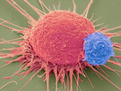 Terapi CAR-T Terbaru Perpanjang Hidup Pasien Kanker Tumor Padat di China